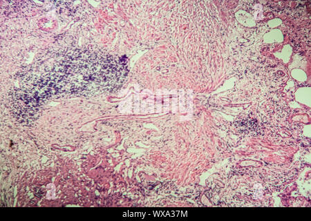 Zyste adenolymphoma krankes Gewebe unter dem Mikroskop 100x Stockfoto