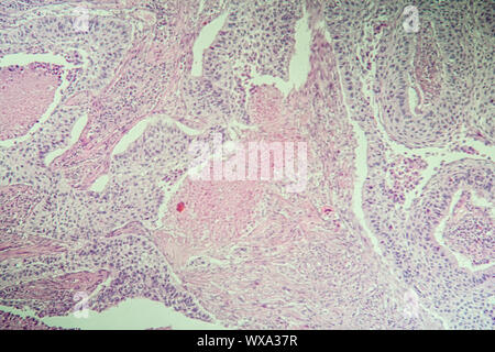 Zellulären Karzinom erkrankten Gewebe unter dem Mikroskop 100x Stockfoto