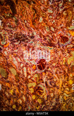 Niere Blutungen krankes Gewebe unter dem Mikroskop 100x Stockfoto