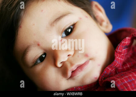 Baby Boy mit Windpocken closeup Stockfoto