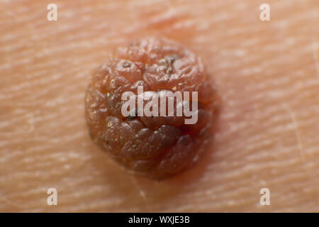 Mole auf der Haut des Körpers. Muttermal. Acrochordon Stockfoto