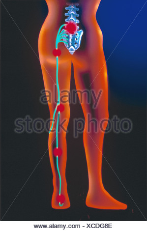Schmerzhafte Ischiasnerv, artwork Stockfoto, Bild 65217514 Alamy