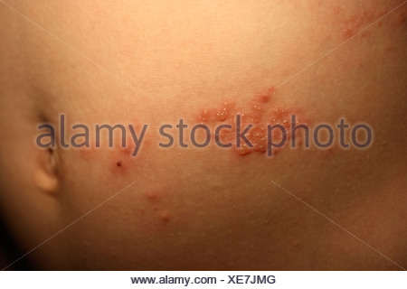 Herpes Zoster Gürtelrose Hautausschlag Stockfoto, Bild: 3217471 - Alamy