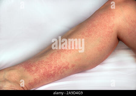 Erupciones alérgicas fuerte en la pierna. Inmunidad deficiente y reacción a los productos alérgenos. Dermatológicos erupción en la piel y el cuerpo. El problema de la HEA Foto de stock