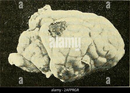 . Physiologische und klinische Untersuchungen über das Gehirn, gesammelte Abhandlungen. Fiff. 232.. Fi. Foto de stock
