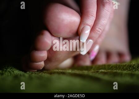 Dedos appling loción en pie con infección micótica. Althele pie puede causar graves picazón, ampollas y apestosa feets reddness Foto de stock
