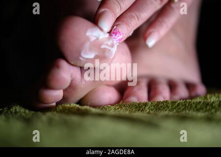 Dedos appling loción en pie con infección micótica. Althele pie puede causar graves picazón, ampollas y apestosa feets reddness Foto de stock