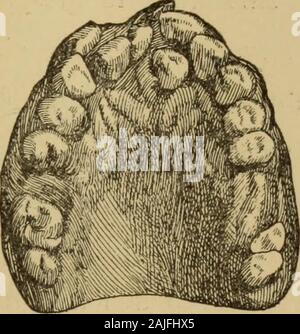 I problemi della degenerazione . FUSIONE DENTARIA - 355 - gior cospicuità degl inferiori ai supe-riori rispetto e en questi degli esterni rispetto ai mediani,T enorme grossezza degli unicuspidi, il loro en curvamento, la loro belluino sporgenza (tipo), il. Incisivi Eterotopia dei denti. (Talbot).Fig. 14. crescere invece che Il primo alterzo decrescere dal dei grossi molari (attributo lacomparsa scimiesco ), en quelli del mascellar Superiore di unquarto tubercolo (nei Platerrini ), la vitalitàdel dente della saggezza, che nelle razze incoltesembra mancare hombres sovente che nelle incivi-lite