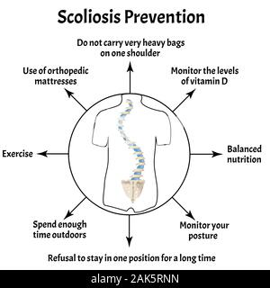 Los síntomas de la cifosis. Curvatura vertebral, cifosis, lordosis ...