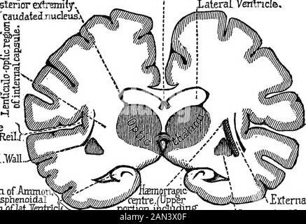 Conferencias sobre localización de enfermedades cerebrales, dictadas en el Faulté de médecine, París, 1875 . Distinction.Ya hemos dicho que los síntomas difieren según la parte de la cápsula interna afectada por la lesión. Si ocupa alguna parte de las dos terceras partes anteriores de la lecápula, la región donde el tracto blanco separa el extremo del ante-rior del ganglio lenticular de la cabeza del ganglio audado, y que pertenecen, como ustedes saben, al campo de la arteria lenticulo-estriada, h& parálisis será ex-clusively que oi movimiento ; no habrá duradero tr