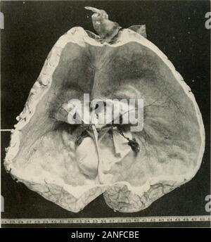 AMAarchives de Neurología y Psiquiatría . ^ u ?^^^- ^h^^^ing. Entre las hemi-P eres. La zona de engrosamiento de la membrana que recubre el dermoide aracnoideos Pfiysical E.ramlmiton-La natiVnt ,..^ , ^ n j . hijo con evidente hvdro^epha us Th T ° ^ ^ ^^^^^ o 71 1 rn. rr -^°^^I^^s. La circunferencia de la cabeza era de 28 pulgadas d. En De ,^r 1 r^ ^^^^ ^f ^ ^^-- °F ^él cráneo y greln^ht. Ella tenía un persistente nistagmo lateral a la derecha y la izquierda, y 280 de neurología y ISVCIIIATKY AKCllllIiS también hacia arriba. Había una clara descoordinación de las manos. Se alarge parche de craniotal)es de OC