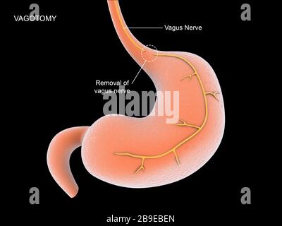 vagotomía y piloroplastia