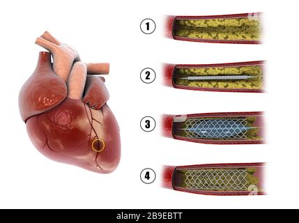 Diagrama que muestra el procedimiento de angioplastia con balón para ensanchar las arterias obstruidas en el corazón. Foto de stock