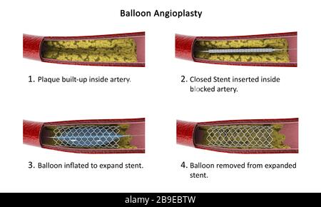 Diagrama que muestra el procedimiento de angioplastia con balón. Foto de stock