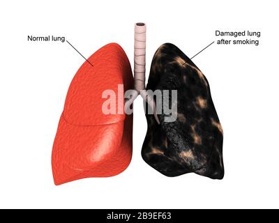 Comparación de un pulmón sano frente a un pulmón fumador. Foto de stock