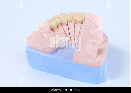 Corona de dientes de cerámica en modelo de yeso Foto de stock