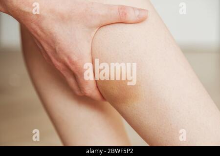 Hematoma on the female butt leg. Woman buttocks bruise. Domestic