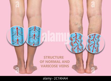 Venas varicosas en las piernas mayores femeninas. La estructura de las venas normales y varicosas. Concepto de piel seca, ancianos, venas varicosas y trombosis venosa profunda o TVP Foto de stock