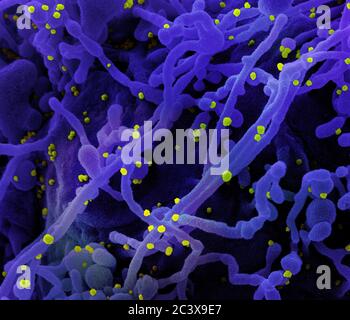 Nuevo Coronavirus SARS-CoV-2 Micrografía electrónica de exploración coloreada de una célula (púrpura) infectada con partículas del virus SARS-COV-2 (amarillo), aislada de una muestra de paciente. Imagen capturada en el Centro de Investigación integrada NIAID (IRF) en Fort Detrick, Maryland. Foto de stock