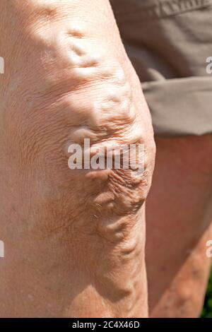 Venas varicosas hinchadas en la rodilla de la mujer anciana Reino Unido Foto de stock