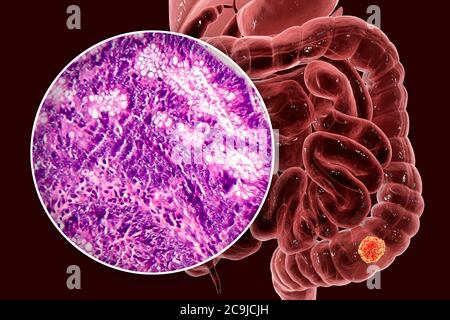 Cáncer de colon, ilustración por computadora y micrográfico ligero que muestra adenocarcinoma de colon. Foto de stock