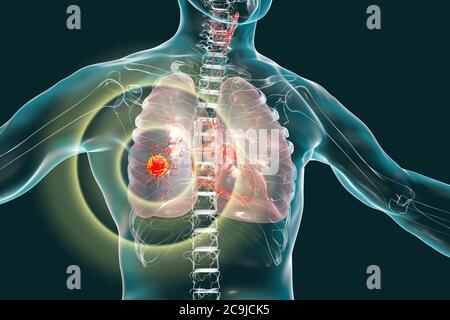Ilustración médica mostrando cáncer de pulmón o carcinoma bronquial sobre fondo negro