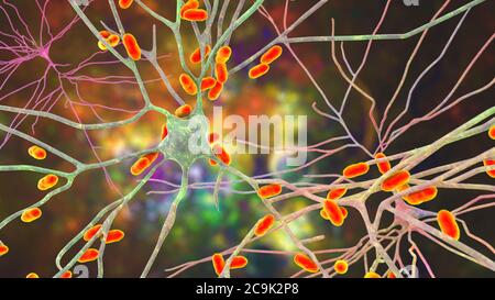 Encefalitis bacteriana. Ilustración conceptual de la computadora que muestra las bacterias que infectan las células cerebrales. Foto de stock