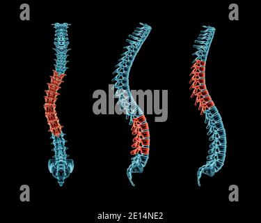 Radiografía columna vertebral con postura de lordosis y vértebras  patológicas resaltadas en rojo. Curvatura humana del trastorno de la  columna vertebral representación 3D illustrati Fotografía de stock - Alamy