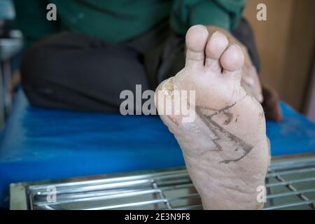 Herida infectada de pie diabético, concepto de atención médica Foto de stock