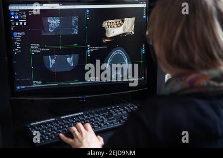 Reconstrucción 3D a partir de una imagen de escáner de la mandíbula de un paciente para una impresión 3D personalizada.