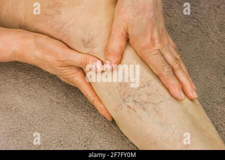 Las manos de una mujer anciana se muestran en las venas varicosas, piernas enfermas. Foto de stock
