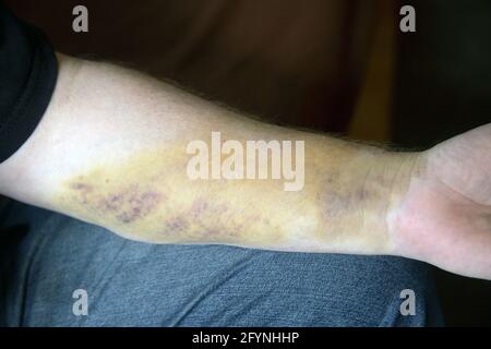 Reacción alérgica fuerte a un medicamento en el brazo Foto de stock