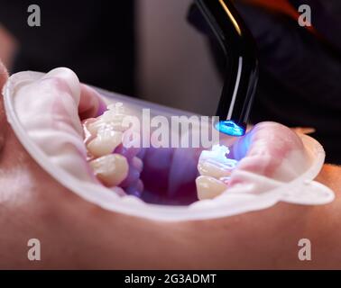 Vista de cerca de la mano del dentista en un guante negro con lámpara UV de curado dental en los dientes del paciente. Retractor de mejillas en los labios. Vista lateral. Concepto de procedimientos dentales Foto de stock