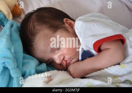 Bebé con labio leporino y paladar hendido. Foto de stock