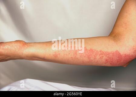 Erupciones alérgicas fuerte en el brazo. Inmunidad deficiente y reacción a los productos alérgenos. Dermatológicos erupción en la piel y el cuerpo. problema estético Foto de stock