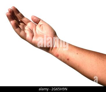 Erupciones y ampollas rojas en la piel del brazo humano y la mano islada sobre fondo blanco, irritación de veneno de insecto, la erupción y los golpes se causa Foto de stock