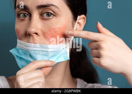 Rosácea. El retrato de cerca de una mujer joven muestra enrojecimiento en sus mejillas por usar una máscara protectora. Fondo azul. El concepto de maskne y esquí Foto de stock