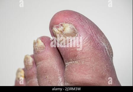 Las infecciones micóticas de las uñas son infecciones comunes de las uñas de los pies que pueden causar que las uñas se descoloren, espesen y con mayor probabilidad de agrietarse y romperse. Foto de stock