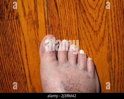 Las infecciones micóticas de las uñas son infecciones comunes de las uñas de los pies que pueden causar que las uñas se descoloren, espesen y con mayor probabilidad de agrietarse y romperse. Foto de stock