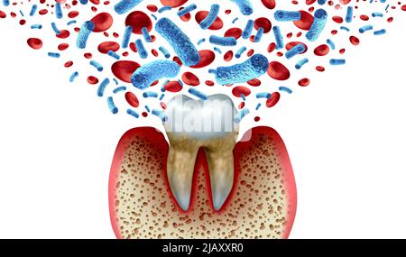 Caries dentales y bacterias y enfermedades de la sangre como un molar malsano con periodontitis debido a problemas de salud de higiene oral pobres como una infección bacteriana. Foto de stock