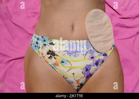 Abdomen de la mujer acostada en la playa con una bolsa de colostomía  Fotografía de stock - Alamy