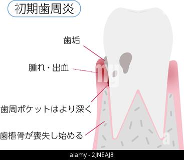 Ilustraci N Por Etapa De La Enfermedad Periodontal Periodontitis Temprana Traducci N