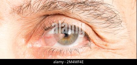Macro del ojo de un adulto mayor afectado por pterigión, una membrana triangular en forma de ala que se produce en los ojos que reduce la visión de varias maneras Foto de stock
