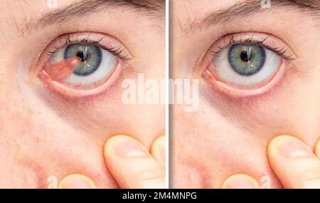 Macro de un ojo azul de una niña afectada por pterigión antes y después de la extirpación quirúrgica, una membrana triangular en forma de ala que se produce en los ojos que se enrojece Foto de stock