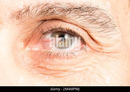 Macro del ojo de un adulto mayor afectado por pterigión, una membrana triangular en forma de ala que se produce en los ojos que reduce la visión de varias maneras Foto de stock