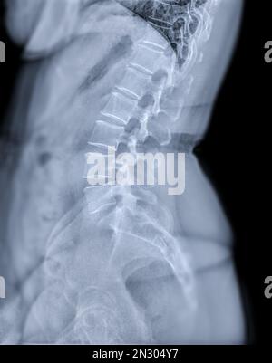 Imagen de rayos X de la columna lumbar o de la columna izquierda