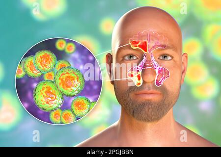 La Bacteria Moraxella Catarrhalis Como Causa De Sinusitis. Ilustración ...