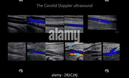 Una Ecograf A Doppler De La Arteria Car Tida Es Una Prueba De