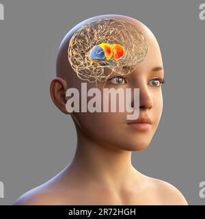 Estriado dorsal resaltado en el cerebro del niño y la vista de cerca de sus neuronas, ilustración por computadora. Es un núcleo en los ganglios basales, un componente Foto de stock