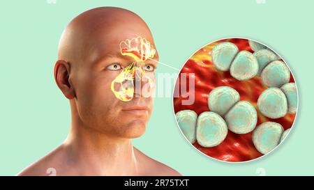 Bacteria Streptococcus pneumoniae como causa de sinusitis. Ilustración por computadora que muestra inflamación de los senos maxilares y vista de primer plano de neumo Foto de stock